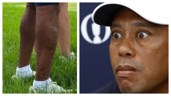 HORRIBLE: Tiger Woods’ disfigured legs were photographed in public without sleeves.